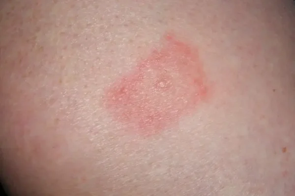 The Ultimate Guide to Lyme Disease Natural Treatment