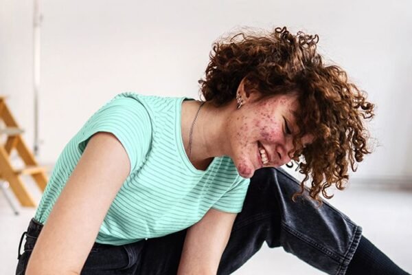 GRt female with acne smiling 732x549 thumb.jpg