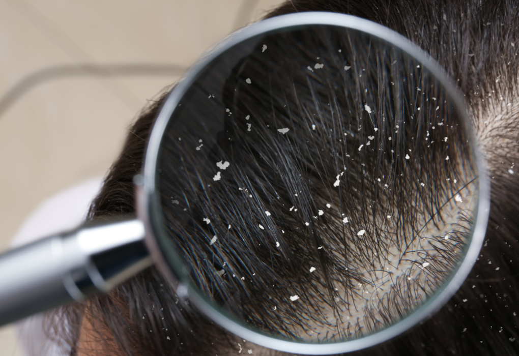 Dry Scalp vs Dandruff 1024x732.png