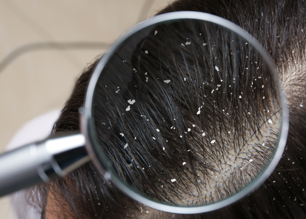 Dry Scalp vs Dandruff 1024x732.png
